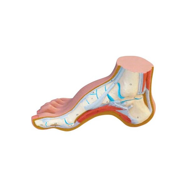3B Anatomical Model - Hollow Foot (Pes Cavus)